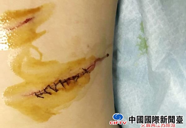 业主胸部伤口.jpg